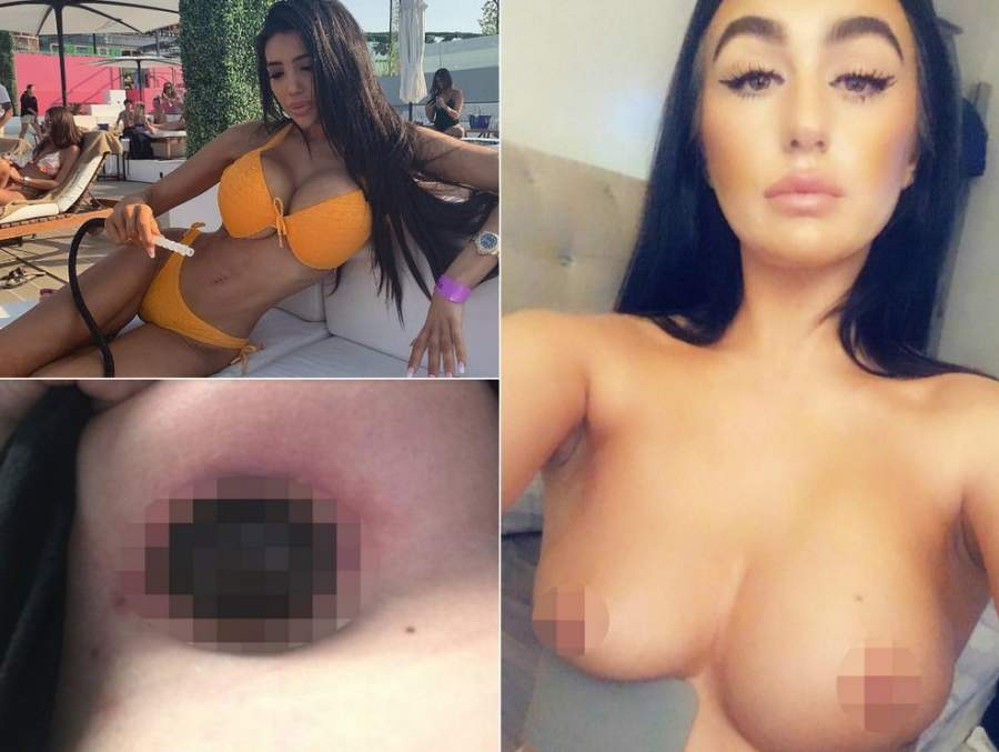 Британка хотела сэкономить на увеличении груди, а получился ужас