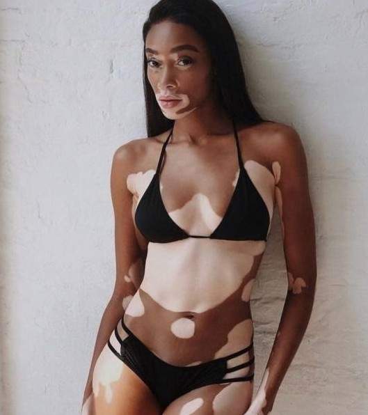 Девушка с пятнами на коже модель